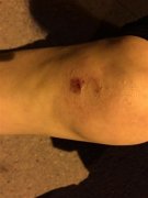 澳门威尼斯人网站：500米路段分布数百颗路钉 行人被绊倒髌骨骨裂